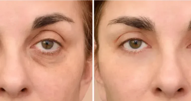 Bolsas y ojeras